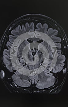Phottography of human brain MRI in coronal view