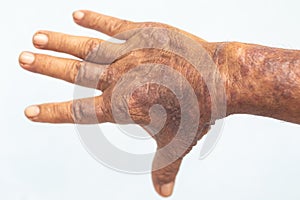 A physical of Atopic dermatitis AD, also known as atopic eczema