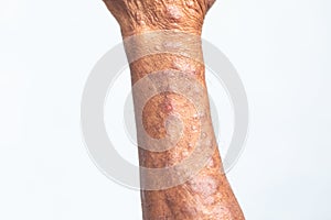 A physical of Atopic dermatitis AD, also known as atopic eczema