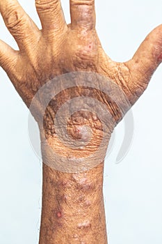 A physical of Atopic dermatitis AD, also known as atopic eczema