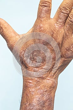 A physical of Atopic dermatitis AD, also known as atopic eczema