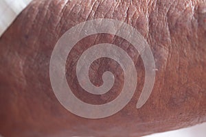 A physical of Atopic dermatitis AD, also known as atopic eczema