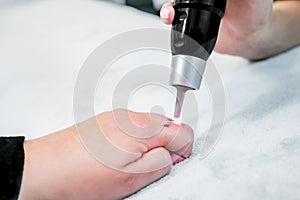Picosecond laser tattoo removal on a small black tattoo on a patient`s finger, in a skincare clinic, with a beautician administeri