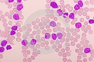Picture of acute lymphocytic leukemia or ALL