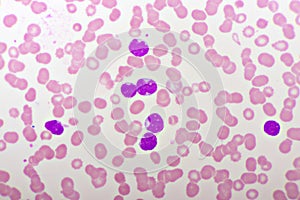 Picture of acute lymphocytic leukemia or ALL cells