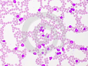 Picture of acute lymphocytic leukemia or ALL cells in blood smear