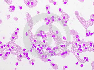 Picture of acute lymphocytic leukemia or ALL cells in blood smear