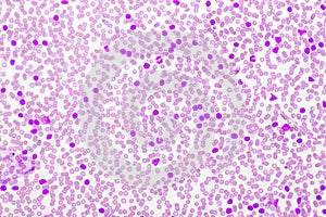 Picture of acute lymphocytic leukemia or ALL cells in blood smear