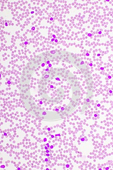 Picture of acute lymphocytic leukemia or ALL cells in blood smear