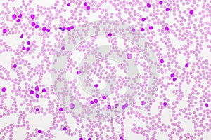 Picture of acute lymphocytic leukemia or ALL cells in blood smear