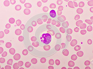 Picture of acute lymphocytic leukemia or ALL cells in blood smear