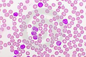 Picture of acute lymphocytic leukemia or ALL cells in blood smear photo