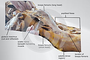 picture of back of the thigh from lateral side showing biceps femoris both head photo