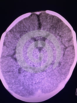 Brain computed tomography photo