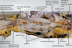 the picture showing the hamstring muscle and nearby anatomy photo