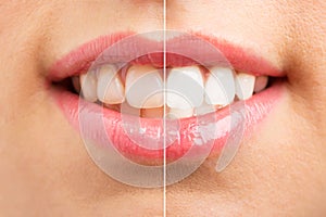 Picture of teeth before and after whitening