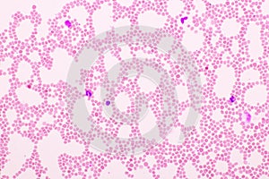 Picture of white blood cell, red blood cell and platelet in blood film