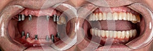 Before and after pictures of dental implants and press ceramic crowns