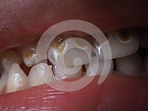 Pictures of kid`s rotten teeth