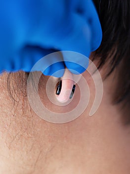 Piercing and stretching the ears with medical  blue gloves. increase the diameter of the ear tunnels