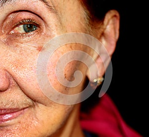 Pigmentation on the face. Brown spot on cheek. Pigment spot on the skin.