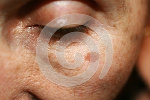 Pigmentation on the face. Brown spot on cheek. Pigment spot on the skin. photo