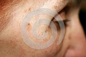 Pigmentation on the face. Brown spot on cheek. Pigment spot on the skin. Profile.