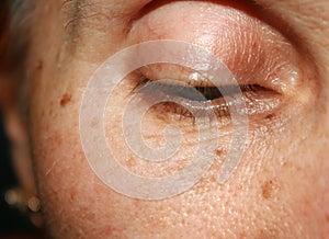 Pigmentation on the face. Brown spot. Wrinkles on the eyelid and under the eye