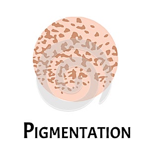 Pigmentation on the skin. A pigmented spot on the skin of the face. Vector illustration