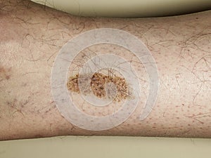 Pigmented birthmarks as a type of wart and pigment spots