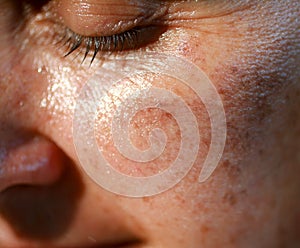 Pigmented spots on the face. Pigmentation on cheeks photo