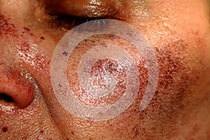 Pigmented spots on the face. Pigmentation on cheeks photo