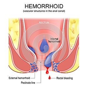 Piles. hemorrhoids. Cross section of the rectum and anal canal