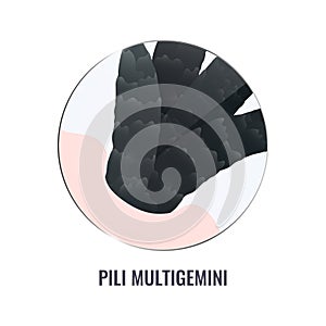 Pili multigemini hair disorder in close up