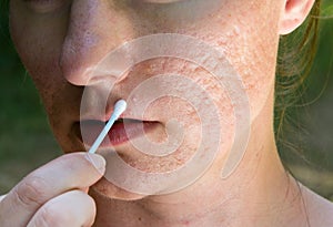 Pimple and acne scars