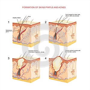 Pimple and acnes