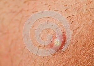 Pimple Extreme Macro