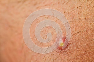 Pimple Extreme Macro