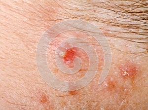 Pimple on human skin macro