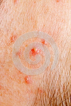 Pimple on human skin macro photo