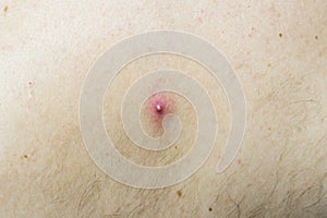 A pimple on the skin of a light-skinned man