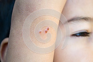 Pimples caused by drains fly on a kid arm
