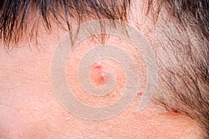 Pimples on the forehead of man. Acne on the forehead