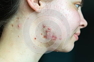 Pimples on the skin of a young girl close-up. Acne on the face of a teenage girl. Problems and treatment of acne in young people.