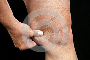 Pinch the fat of the knee