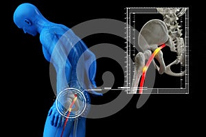 Pinched human sciatic nerve, anatomical vision. 3d illustration