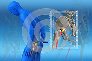 Pinched human sciatic nerve, anatomical vision. 3d illustration