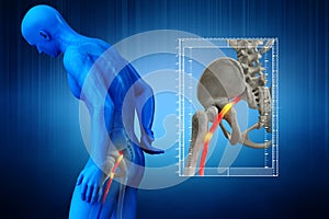 Pinched human sciatic nerve, anatomical vision. 3d illustration