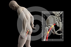 Pinched human sciatic nerve, anatomical vision. 3d illustration