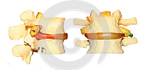 Pinched spinal nerve model